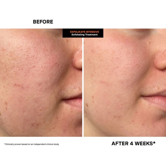 NIB Kate Somerville ExfoliKate Intensive Exfoliating Treatment Tube 5 Fl Oz Skin - Picture 7 of 16